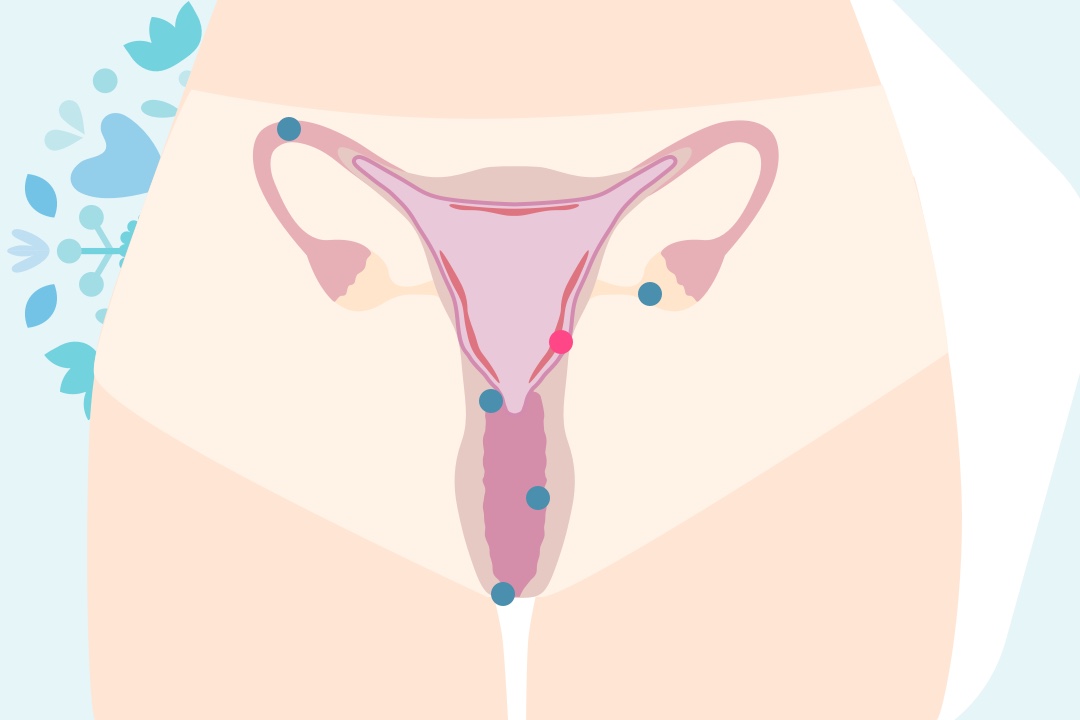 Graphique de l'utérus