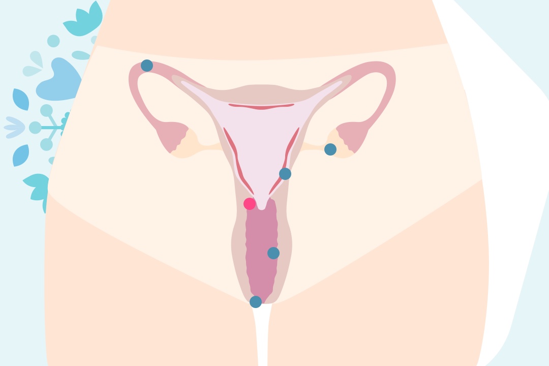 Graphique du col de l'utérus